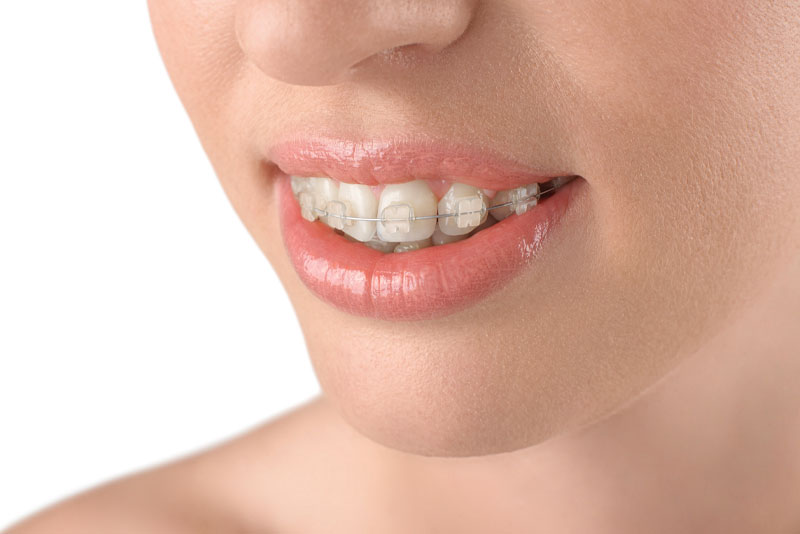 dental patient wearing braces