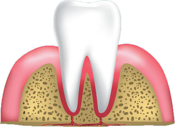 gum disease stage