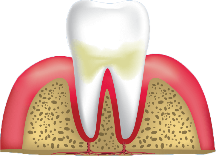 gum disease stage