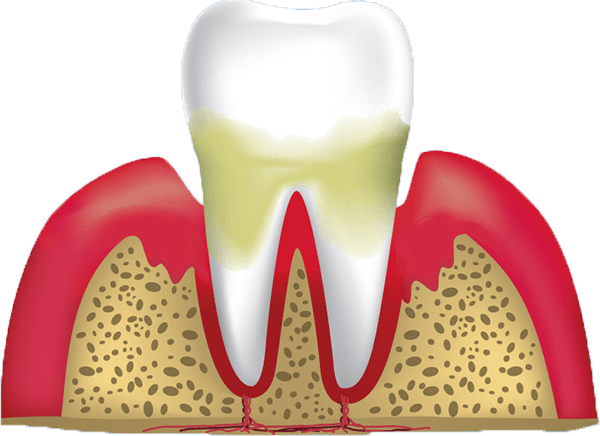 gum disease stage