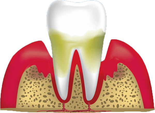 gum disease stage