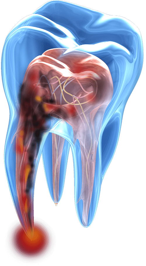 root canal graphic