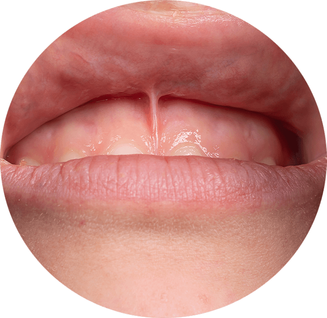 frenectomy