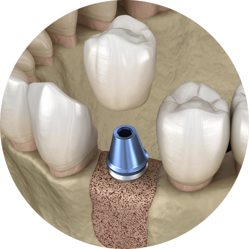 bone grafting