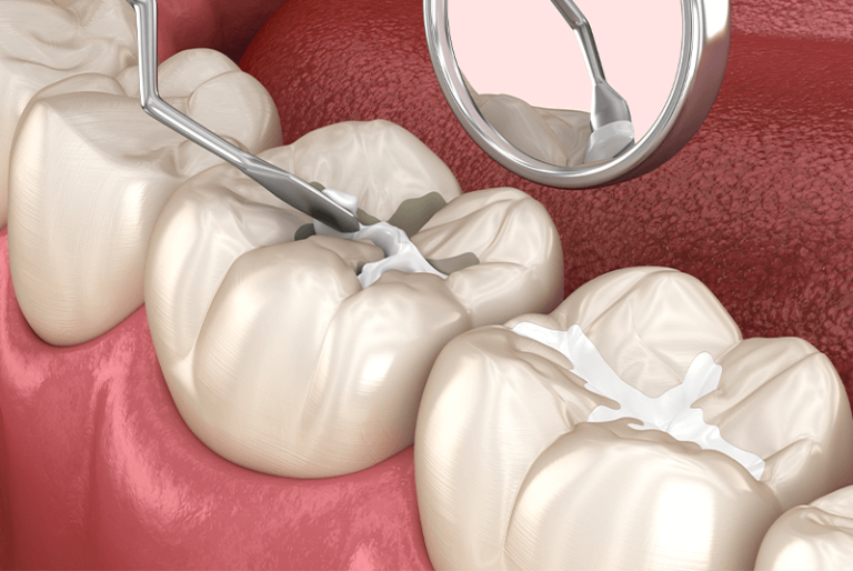 Pulpotomy Near Me Saving Your Tooth Through Expert Care